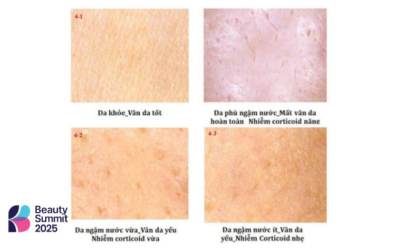 Dấu hiệu da bị nhiễm corticoid theo từng cấp độ Dấu hiệu da bị nhiễm corticoid theo từng cấp độ