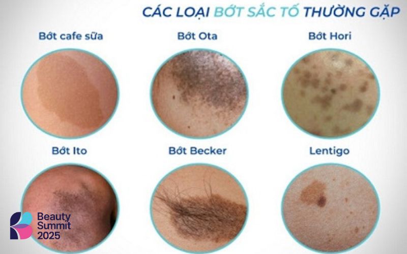 Rối loạn sắc tố da bẩm sinh là gì Rối loạn sắc tố da bẩm sinh là gì