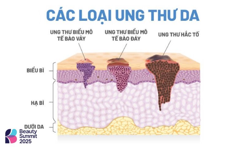 U hắc tố da ác tính