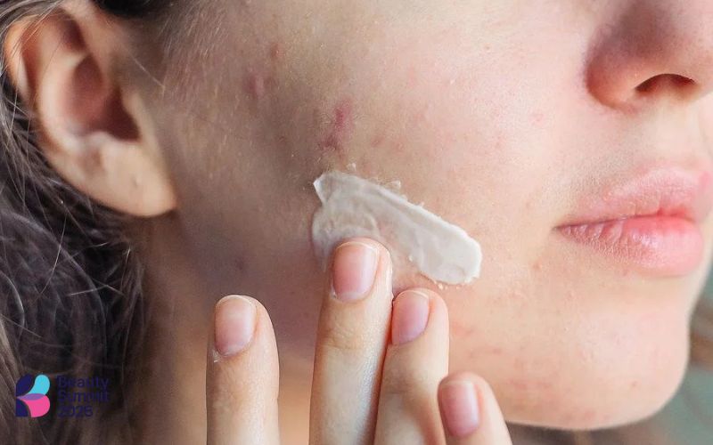 Cách bôi kem chống nắng sau khi nặn mụn
