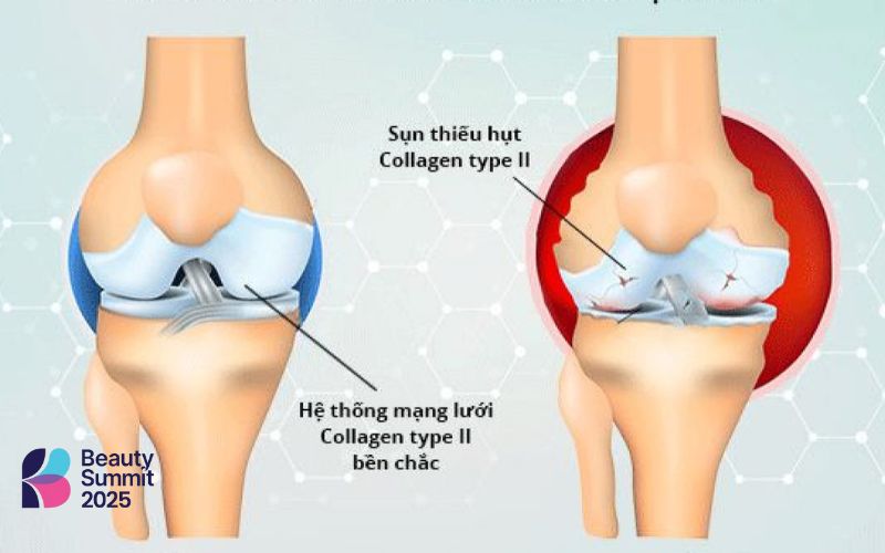 Dấu hiệu xương khớp thiếu hụt collagen và elastin Dấu hiệu xương khớp thiếu hụt collagen và elastin
