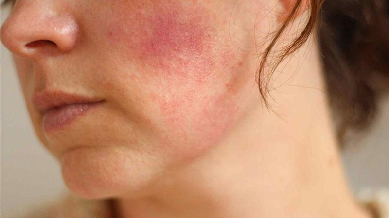 di ung kem chong nang nguyen nhan va cach khac phuc hieu qua 2 b3bb69c266