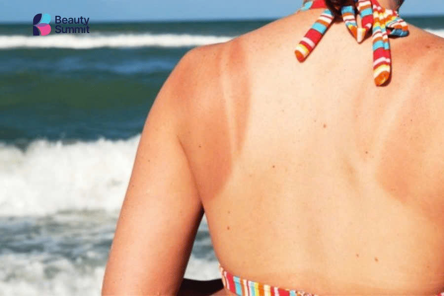 nhả nắng sau khi đi biển thế nào